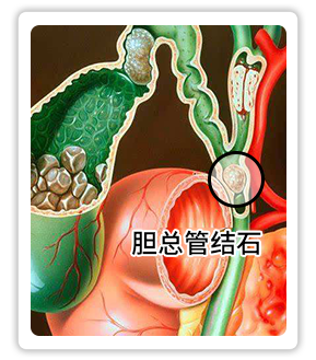 胆总管结石 (1).png